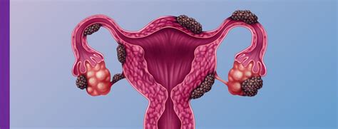 endometriose cid